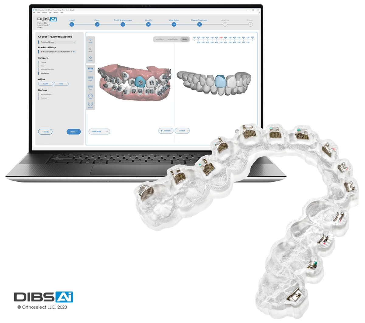 DIBS AI orthodontic planning software on a laptop beside an indirect bonding tray