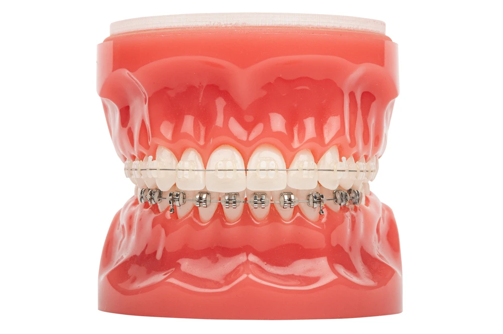 Dental model combining clear ceramic upper braces with metal lower braces