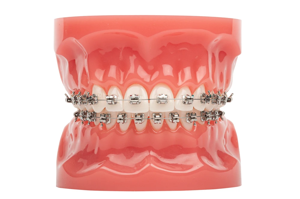 Dental model showing traditional metal brackets and wires on upper and lower teeth